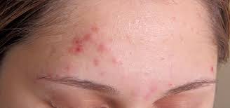 acne
